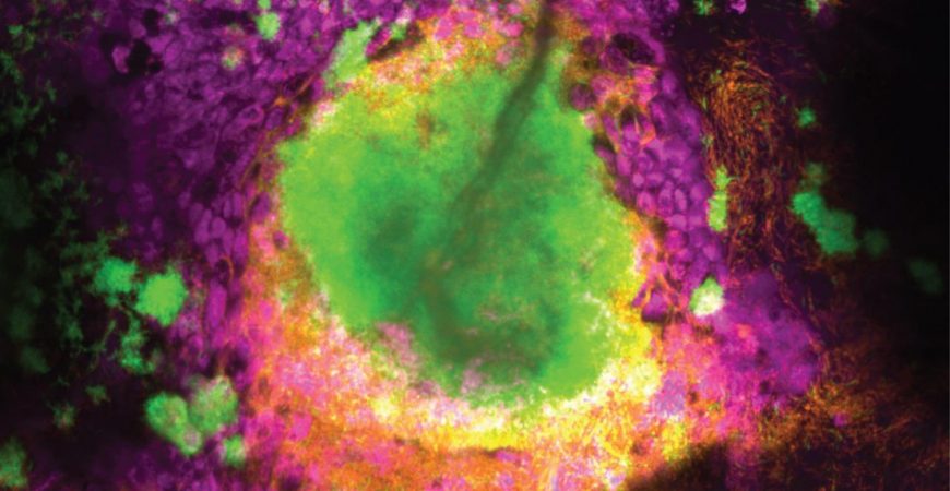 Lung Pathogen’s Dilemma: Infect Or Resist Antibiotics?